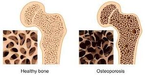 osteoporoza osoasa